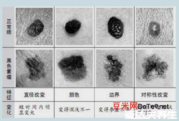 黑色素瘤早期症状图片，和普通黑痣相似但又有五点不同