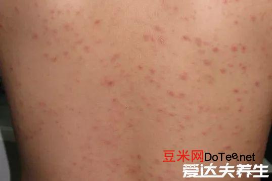 玫瑰糠疹怎么引起的会传染吗，不会传染但病因不详(图片)