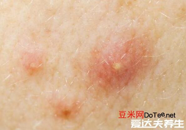 人身上被螨虫咬的图片，出现丘疹性荨麻疹脸部长痘变粗糙