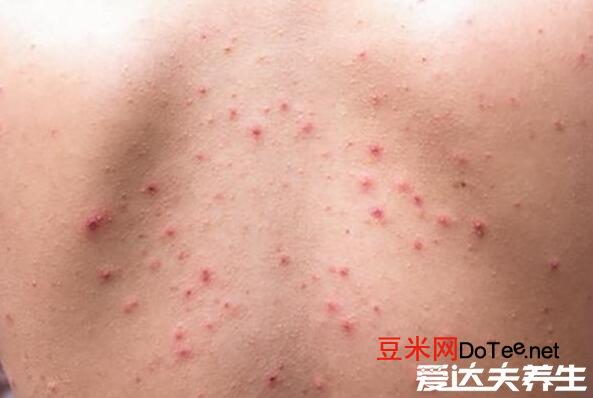 人身上被螨虫咬的图片，出现丘疹性荨麻疹脸部长痘变粗糙