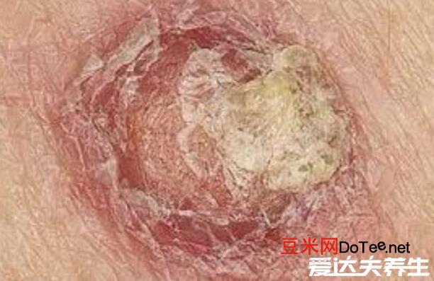 早期皮肤癌图片和症状，最严重的是黑色素瘤会致命