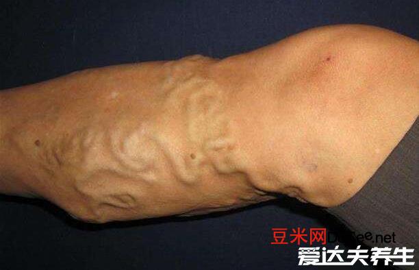 早期小腿静脉曲张图片症状，突出皮肤的血管像蚯蚓一样