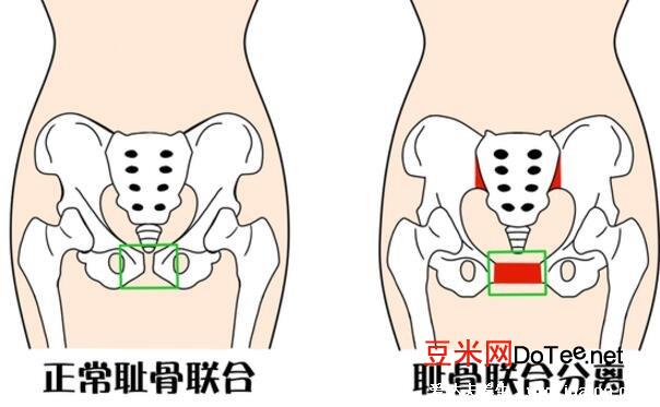 孕妇耻骨在哪个位置示意图片，大腿跟内侧有骨头的地方(附缓解法)