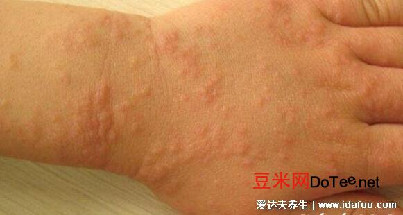 18种常见的皮肤病图片及症状，牛皮癣/荨麻疹/湿疹/皮疹对照合集