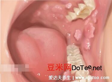 口腔尖锐湿疣图片及症状，初期舌下长米粒状小疣体(口交感染)