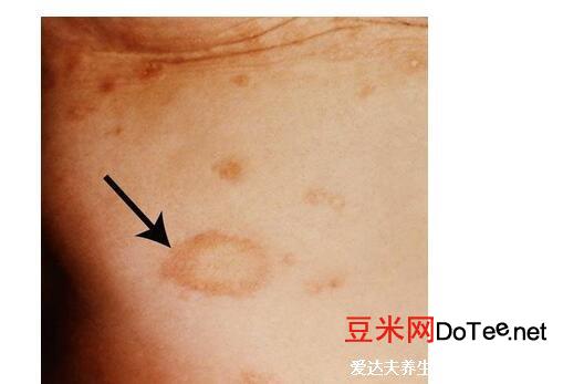 玫瑰糠疹初期症状图片，淡红斑有鳞屑可瘙痒(青年中年易得)
