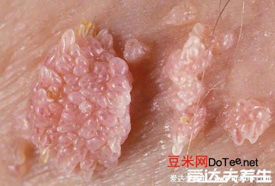 女性假疣和真疣的区别图片，看看尖湿锐尤典型图片(真疣可X接触传染)