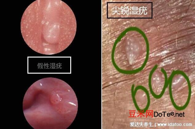 女性假疣和真疣的区别图片，看看尖湿锐尤典型图片(真疣可X接触传染)