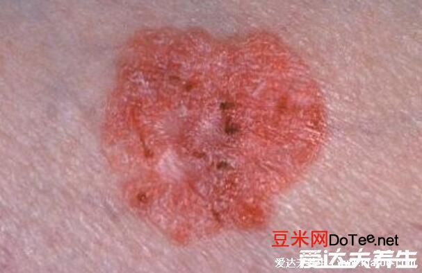 浑身瘙痒是大病的前兆，可能是这些皮肤病(附100种皮肤病对照图)