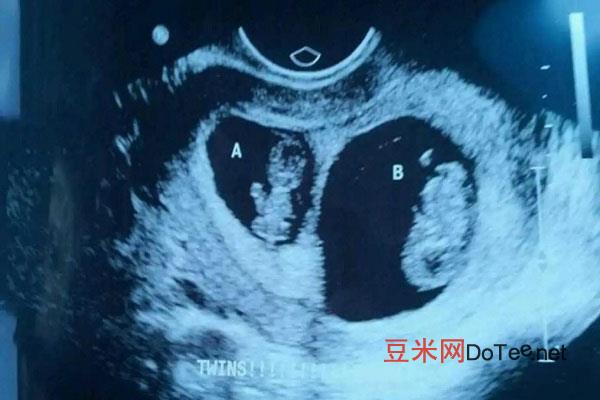 怀孕后什么时候可以查出是双胞胎，容易腹痛是明显特征