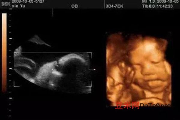 五个月胎儿三维彩超图，胎儿五个月彩超图 怀孕五个月胎儿真实图片