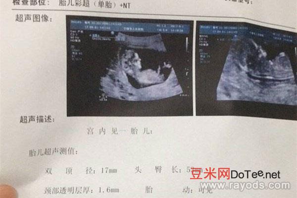 胎囊形状看男女(超准) 生了男孩当时42天孕囊