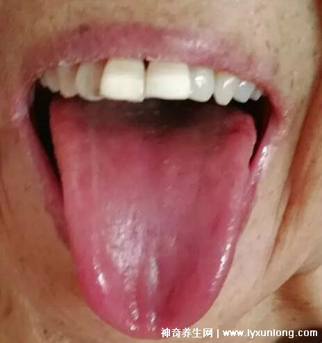 胃癌的早期舌苔图片症状？胃癌舌苔图片 早期