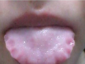 舌头边缘有齿痕是什么原因？舌头有齿痕是什么原因怎么调理