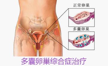 多囊卵巢是什么样的症状？多囊卵巢有什么症状表现