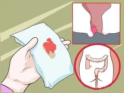 肛门出血是什么原因？肛门出血是什么原因大便纸上带血怎么办