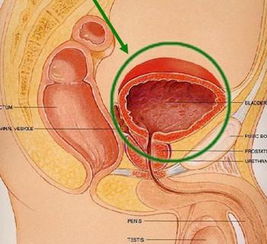前列腺钙化灶什么意思？前列腺钙化灶是什么意思需要治疗吗