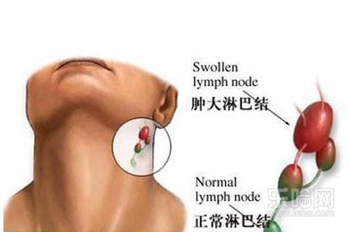 颈部淋巴结肿大是什么原因造成的？儿童颈部淋巴结肿大的原因