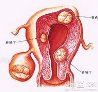 卵巢囊肿是什么原因引起的？女性为什么会得卵巢囊肿的原因
