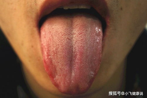 舌苔发白是什么原因呢？舌苔发白是怎么回事吃什么药好