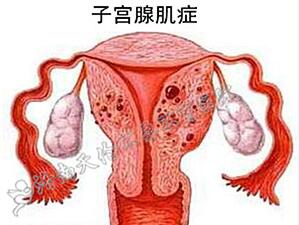 子宫腺肌症是什么病？子宫腺肌症的表现有哪些