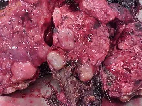 肝内钙化斑图片