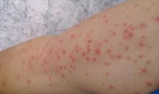 湿疹是什么原因引起的？湿疹是什么原因造成的涂什么药