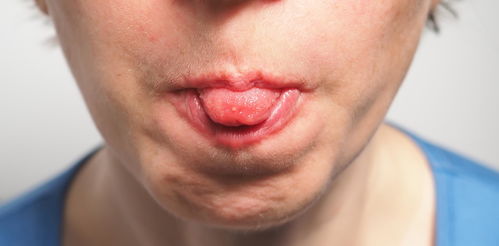 舌头白苔厚是什么原因？舌苔白且厚腻是怎么回事