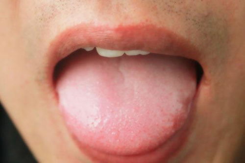 舌苔发白是什么原因？造成舌苔发白的原因有哪些症状