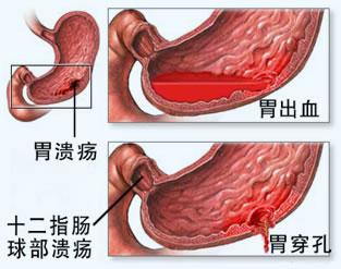 胃出血有什么症状表现？胃出血会痛吗胃出血都会有什么征兆吗