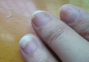 灰指甲用什么药最有效最好能根治？什么产品治疗灰指甲有效