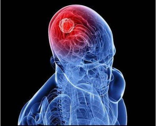 脑瘤早期什么症状？脑瘤早期的症状有什么表现吗