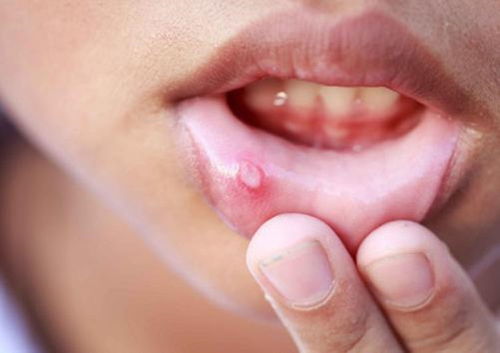 女人长期口腔溃疡是什么原因？一直口腔溃疡是怎么回事女性