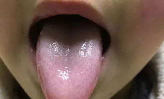 舌苔发黄是什么原因？舌苔偏黄什么情况?