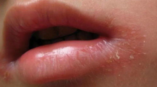 嘴角烂是什么原因造成的？嘴角老烂是什么原因引起的