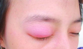 眼皮浮肿是什么原因？眼皮肿胀是什么原因呢?