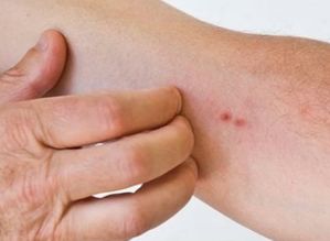皮肤瘙痒是什么原因引起的？皮肤瘙痒怎么回事用什么药