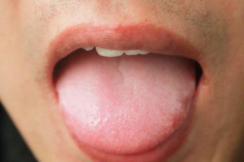 舌苔发黑是什么原因？舌苔发黑是怎么回事
