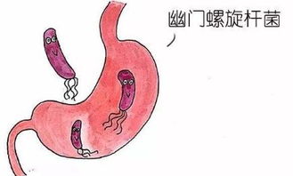 幽门螺旋杆菌阳性是什么意思？胃幽门螺旋杆菌阳性什么意思