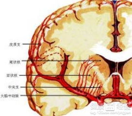 脑梗塞是什么原因引起？脑梗是怎么形成的呢