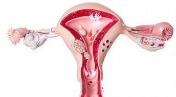 子宫出血是什么原因造成的？子宫异常出血是什么原因造成的吃什么药