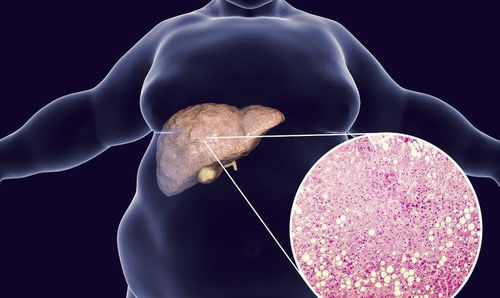 脂肪肝是什么原因造成的？脂肪肝怎么引起的怎么调理