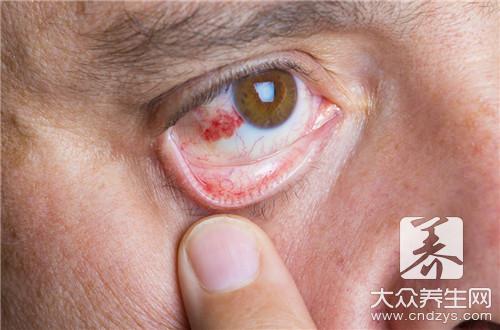 红眼病是怎么传染的？红眼病怎么传染给别人