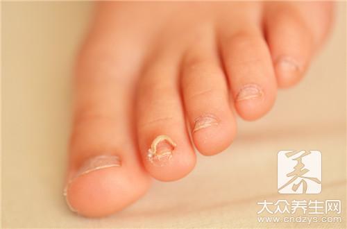 脚部灰指甲治疗的4种偏方