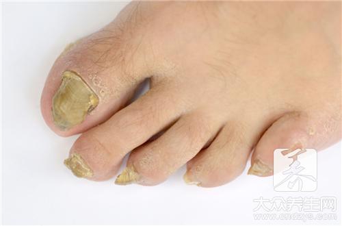 脚指甲变厚的原因？脚指甲变厚是怎么回事