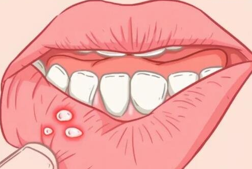 口腔溃疡怎么办最快最有效的方法？口腔溃疡怎么办最快最有效的方法舌头