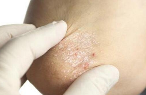 常见湿疹分为五种类型图片？湿疹分几种类型图片