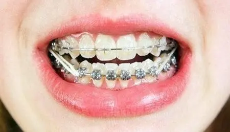 牙齿矫正大概要花费多少钱？牙齿矫正大概要花费多少钱牙套