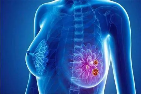 乳腺癌的15个征兆？乳腺癌的15个征兆图片