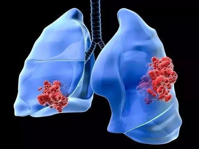 肺癌早期八个信号？肺癌晚期最怕三个征兆